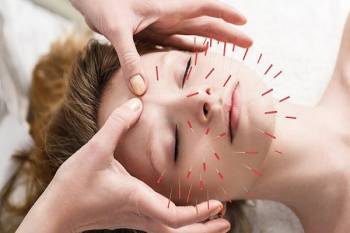 درمان سردرد با طب سوزنی