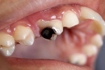پوسیدگی دندان: علائم، دلایل و درمان