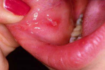 علائم آفت دهان چیست؟