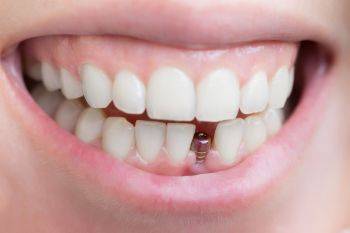 آشنایی با انواع روش کاشت دندان