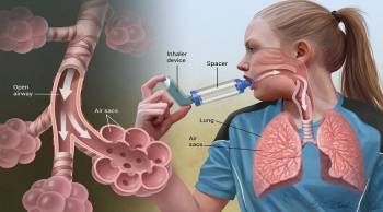 راهکار‌هایی ساده برای جلوگیری از وقوع حمله آسم