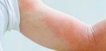دلایل رایج آلرژی‌های پوستی و درماتیت تماسی
