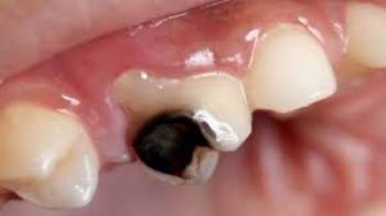 پوسیدگی دندان شایع‌ترین بیماری عفونی انسانی